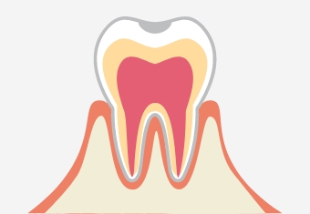 C0／虫歯の前兆