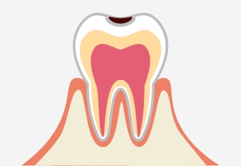 C1／初期の虫歯