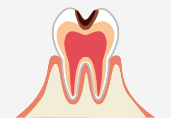 C2／神経の近くまで進行した虫歯