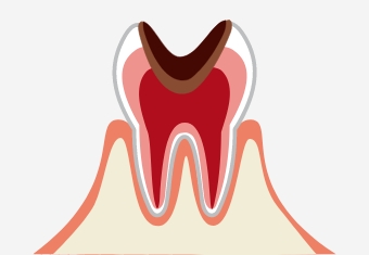 C3／神経まで進行した虫歯