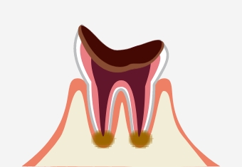 C4／末期の虫歯